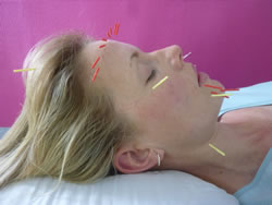 picture of Maria Mercati giving a sciatica treatment