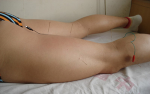 electro acupuncture for pain relief